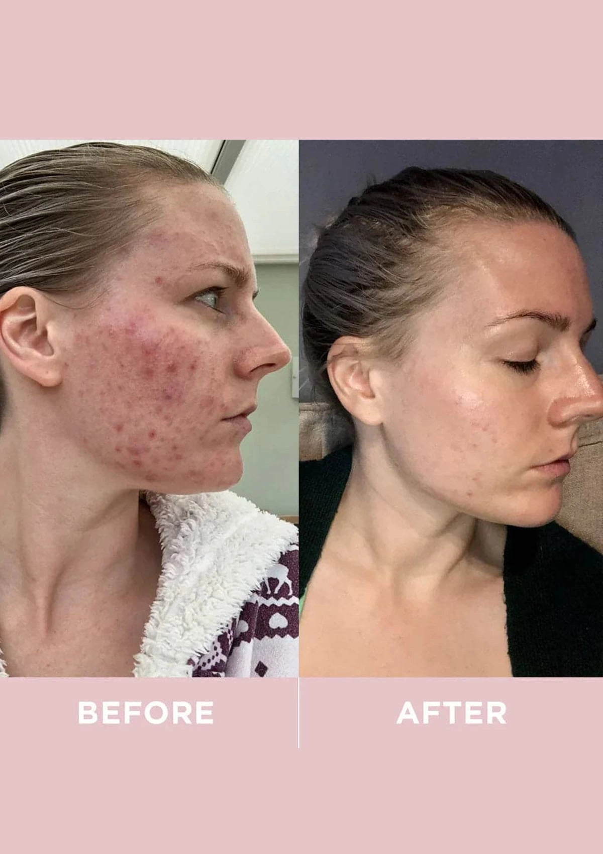 Before and after comparison of a person's face with acne on a pink background