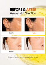 Before and after skin treatment comparison with text 'Glow up with Clear Skin!' on a white background.