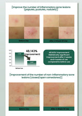 Before and after skin condition improvement chart with acne lesions images and statistical data.