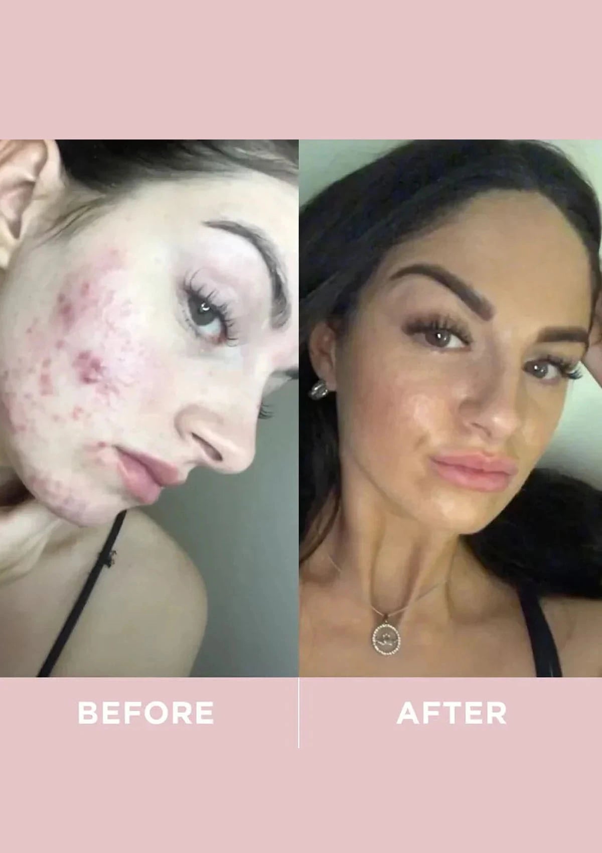 Before and after comparison of a person's face with visible acne on the left, and clearer skin on the right.