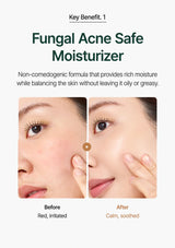 Advertisement for fungal acne safe moisturizer showing a before and after effect on skin.