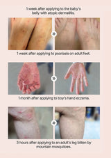 Collage of skin conditions treated with a product, including atopic dermatitis, psoriasis, eczema, and mosquito bite reactions.