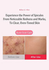 Before and after comparison graphic for acne scar care, showing red, inflamed skin on the left labeled 'Before Use' and clear, even-toned skin on the right labeled 'After Use' with headline text about spicules and clear, even-toned skin on a pale pink background.