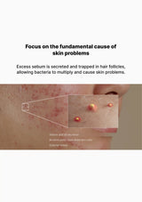 Diagram of skin with text explaining sebum excess and skin problems