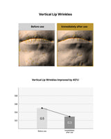 Before and after comparison of vertical lip wrinkles with a graph showing improvement.