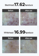 Before and after images showing reduction of blackheads and whiteheads with a skincare product.