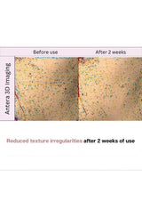 Before and after comparison of skin texture using Antera 3D imaging, showing reduced irregularities after 2 weeks.