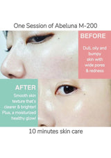 Before and after comparison of skin treatment with Abeluna M-200, showing a person's face with text describing the difference.