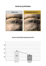 Before and after comparison of vertical lip wrinkles with a graph showing improvement.
