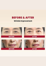 Before and after comparison of wrinkle improvement on a person's face.