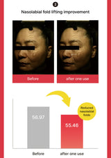 Before and after comparison of nasolabial fold lifting with a graph showing reduction in folds.