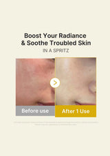 Before and after skin treatment comparison with text 'Boost Your Radiance & Soothe Troubled Skin' on a beige background.
