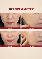Before and after comparison of facial skin treatment on a beige background with 'Before & After' text.