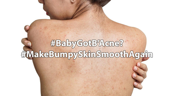 Baby Got B’acne? - COCOMO