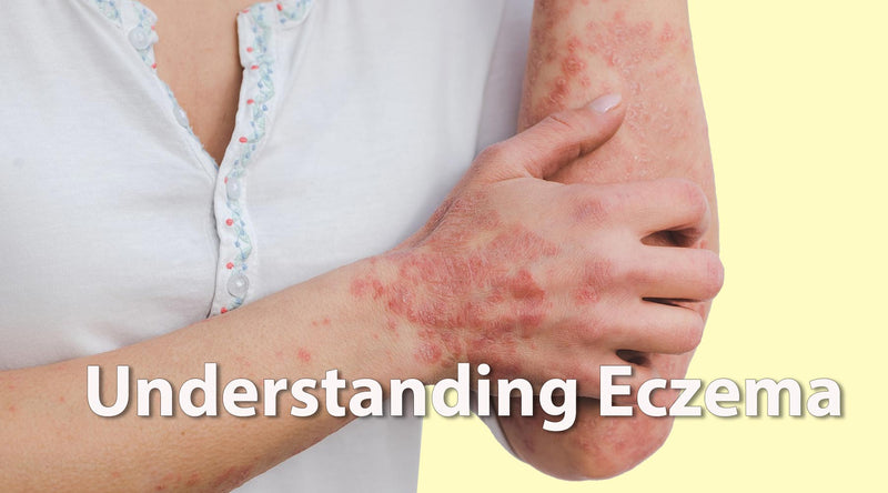 Eczema - COCOMO