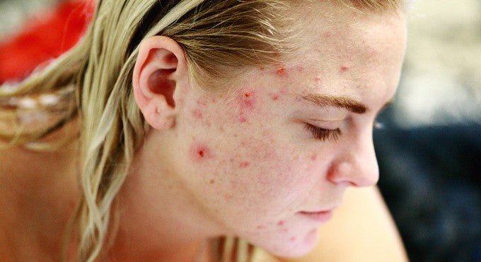 Acne? No Problem! Here’s The 2 Step Secret to Your Dream Skin - COCOMO