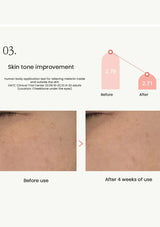Before and after skin tone improvement showing a reduction in melanin levels.