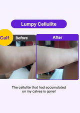 Before and after comparison of lumpy cellulite on a calf with text indicating improvement.