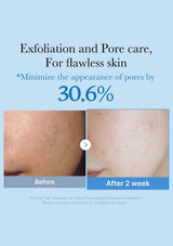 Before and after skin care treatment showing exfoliation and pore care results.