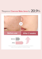 Before and after skin improvement showing 20.9% improvement in uneven skin area.
