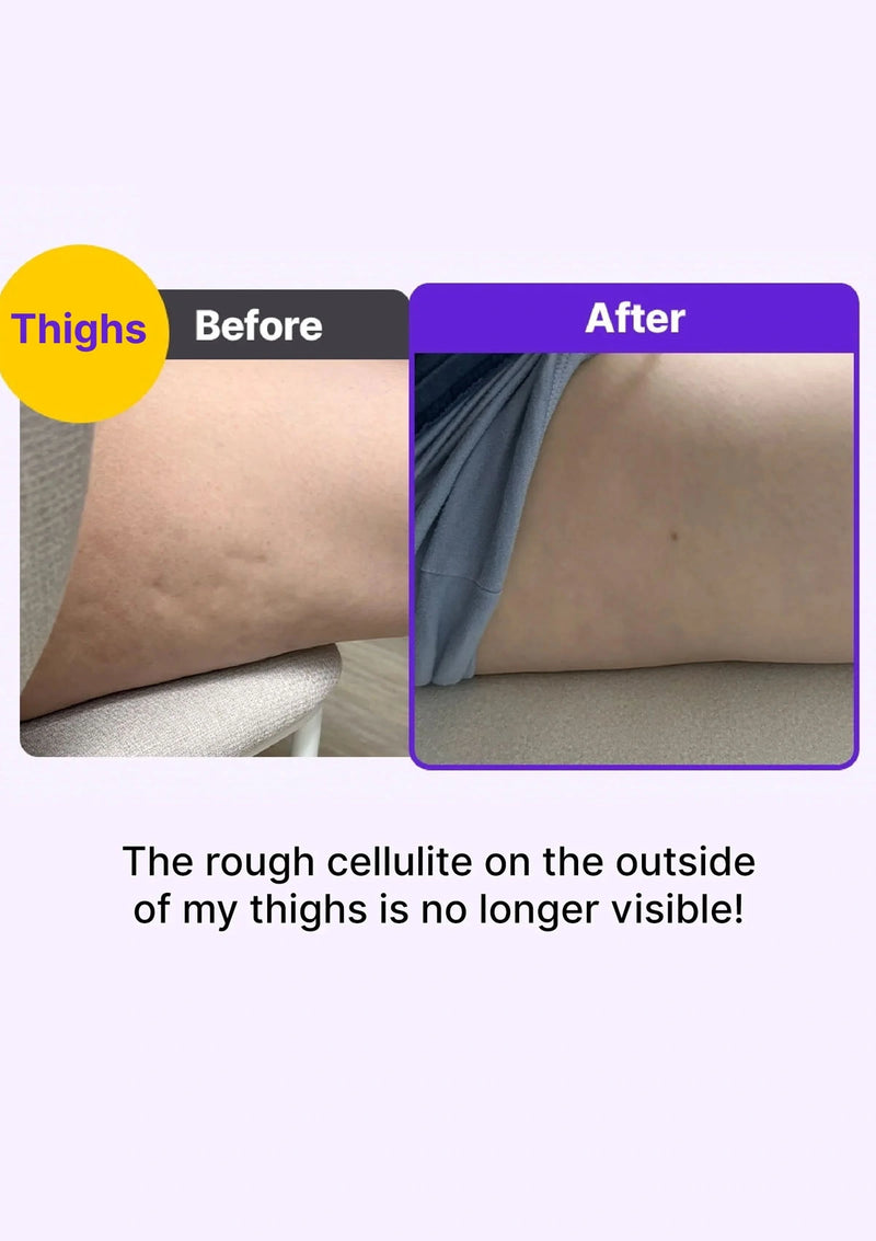 Before and after comparison of rough cellulite on thighs with text indicating improvement.