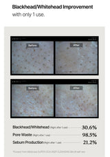 Before and after results of blackhead and whitehead improvement with a skincare product, showing a 30.6% reduction in blackheads/whiteheads, 98.