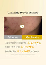 Before and after skin treatment results showing reduced acne and uneven patches.