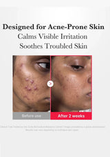 Before and after comparison of acne-prone skin treatment showing calmed irritation and improved skin condition.