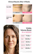 A clinical results infographic showing before-and-after skin texture comparisons for neck and smile lines, alongside a before-and-after face measurement graphic and a percentage volume-boost chart titled 'Visible Volume Boost IN 4 WEEKS'.