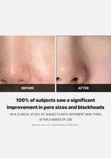 Before and after comparison of skin with pore sizes and blackheads, showing a clinical study result.
