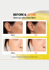 Before and after skin treatment comparison with text 'Glow up with Clear Skin!' on a white background.