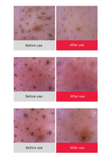 Before and after skin treatment comparison on a white background