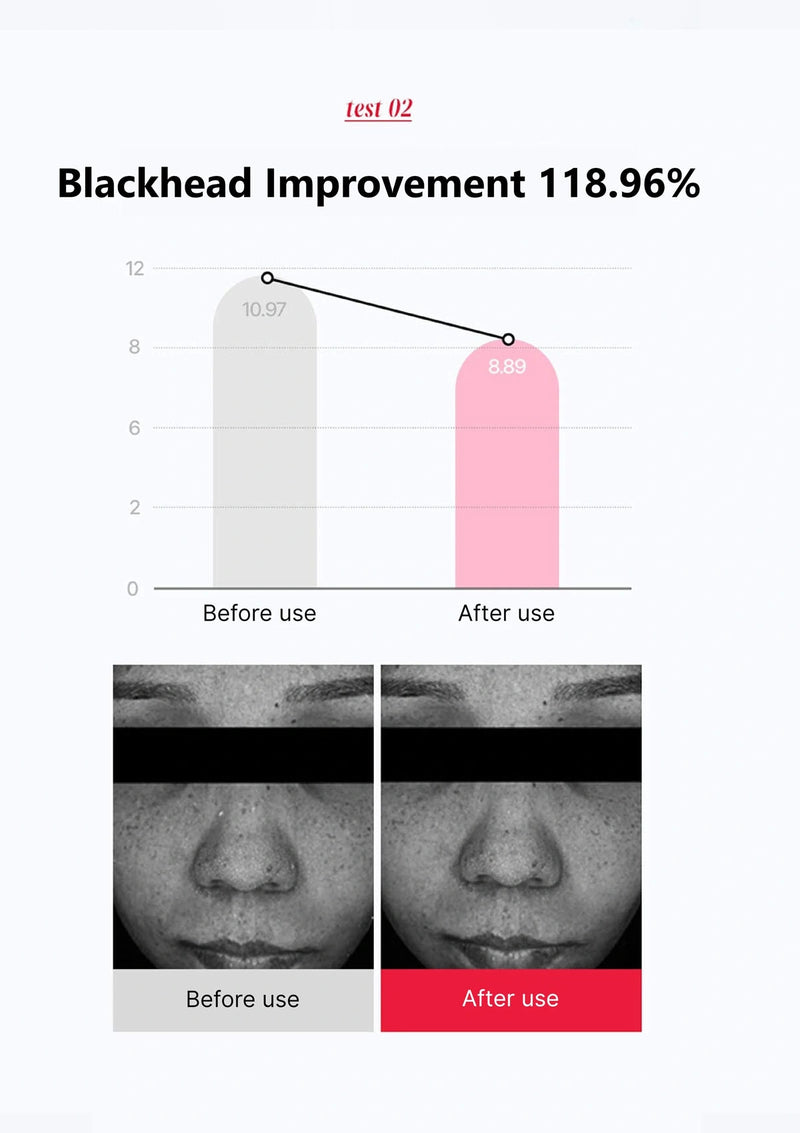 Graph and before/after images showing blackhead improvement with a % increase.
