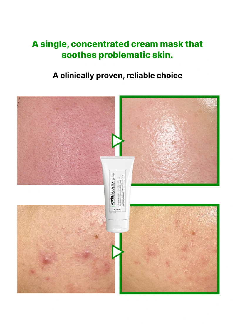 Cream mask for problematic skin with before and after effects on a white background