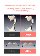 Before and after comparison of a neck treatment with Volufiline, showing firmness enhancement.