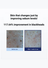 Before and after comparison of skin with blackheads showing 117.64% improvement.