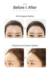Before and after comparison of M-shaped hairline and sparse, uneven hairline on a person.