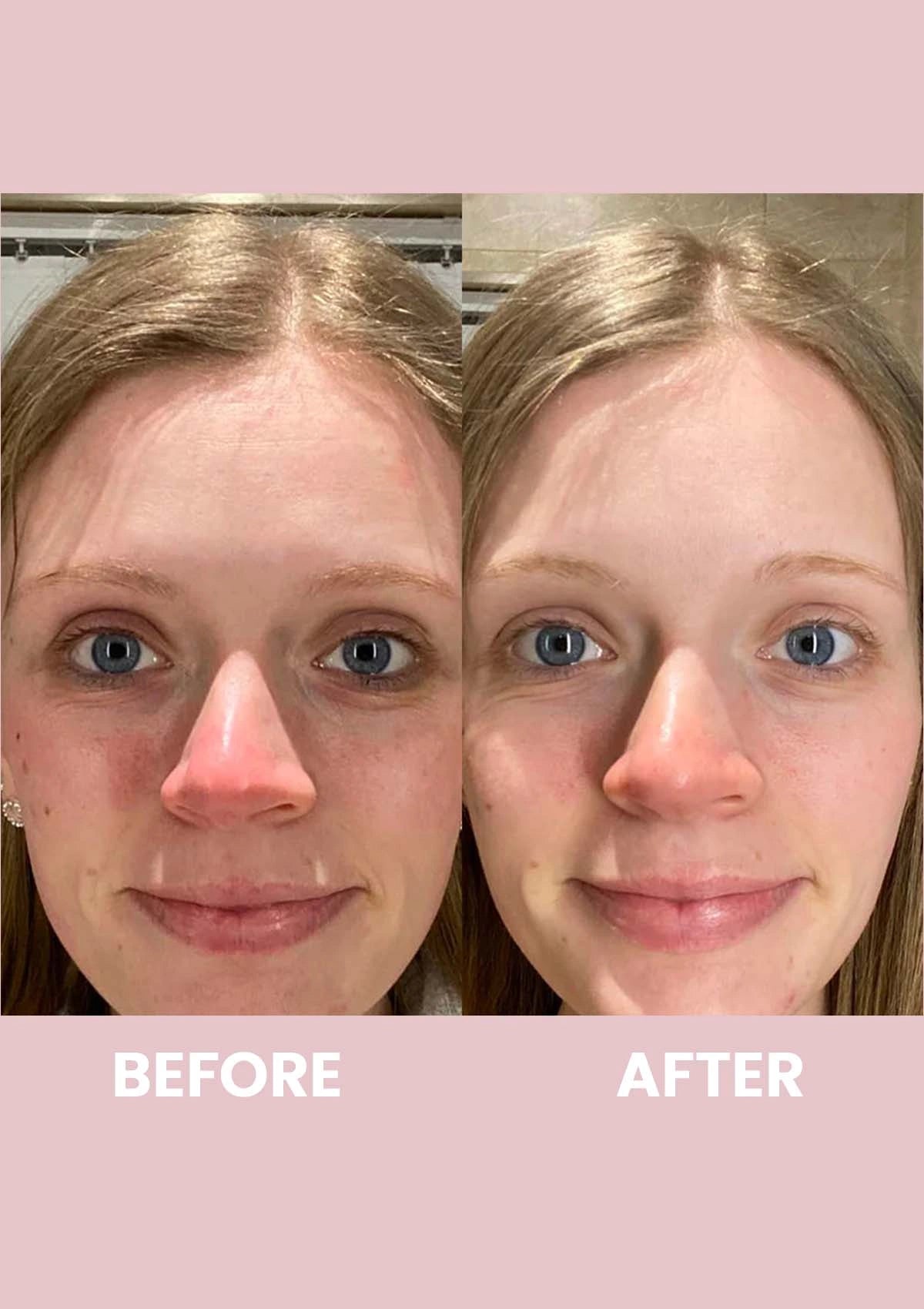 Before and after comparison of a person with visible skin improvement on a pink background