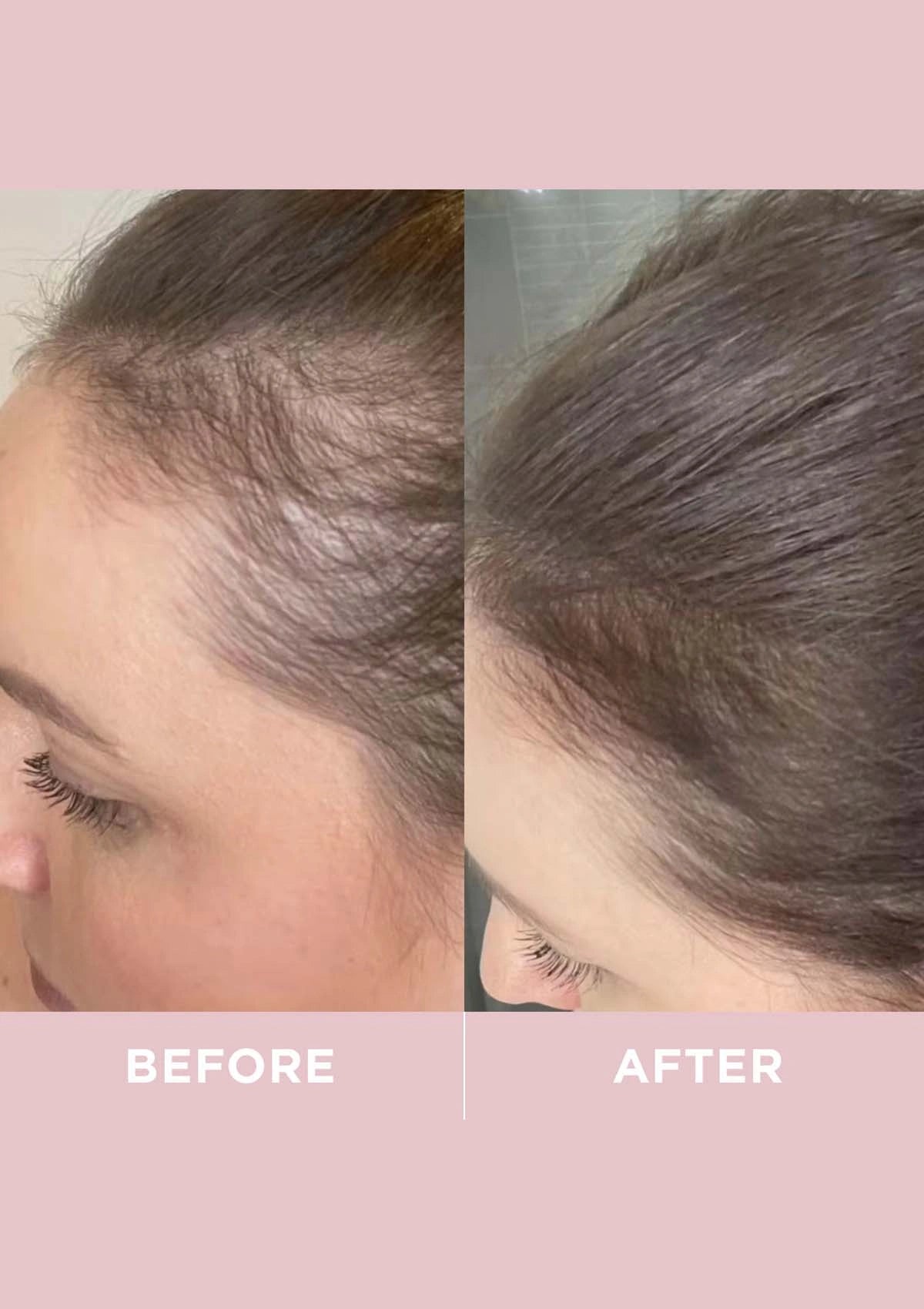 Before and after comparison of hair density on a person's head.