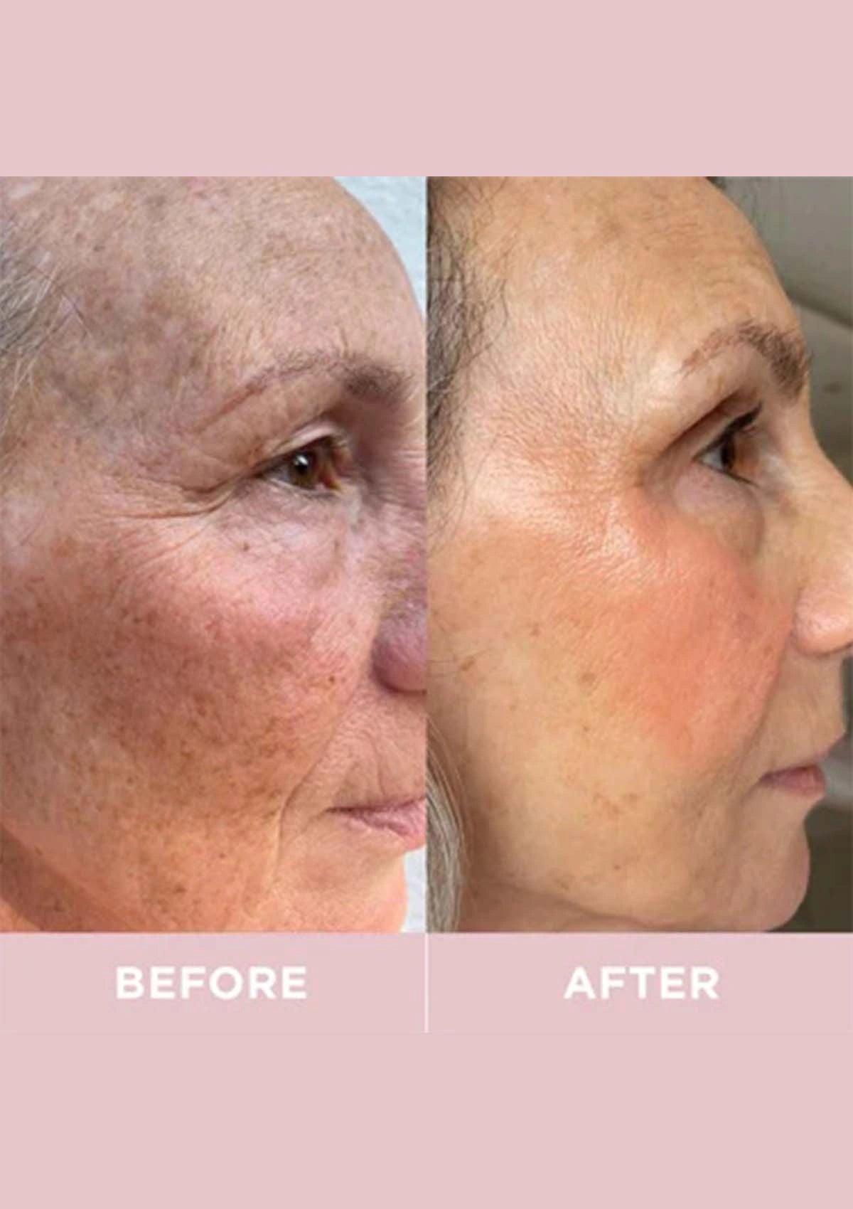 Before and after comparison of a person's face with visible skin texture改善.