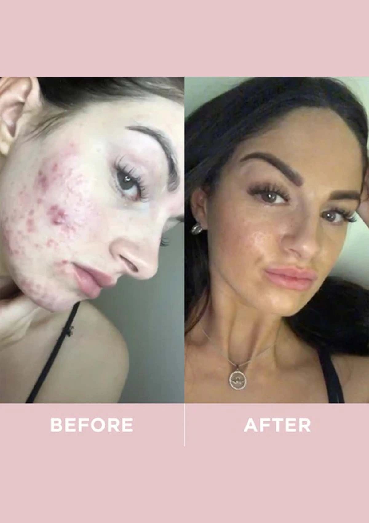 Before and after comparison of a person's face with visible acne on the left and clear skin on the right.