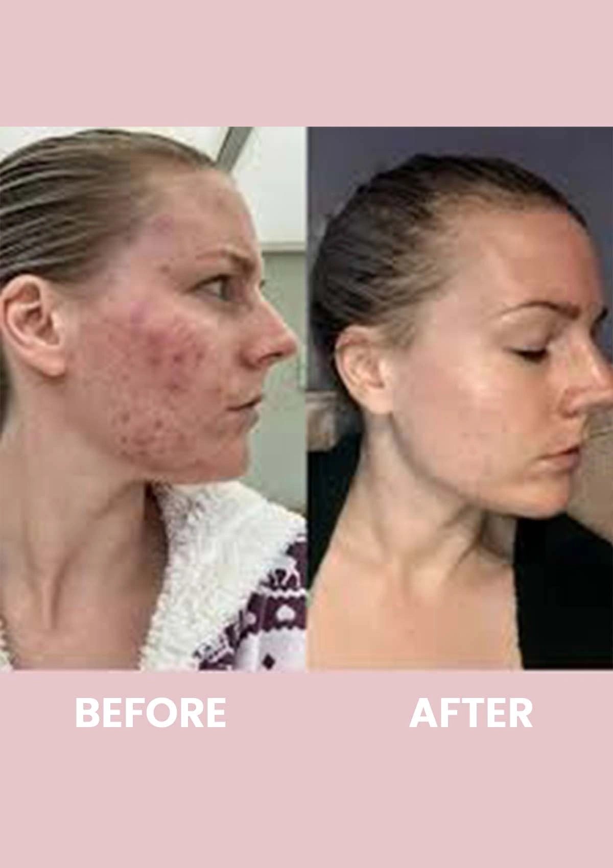Before and after comparison of a woman's face with acne on a pink background
