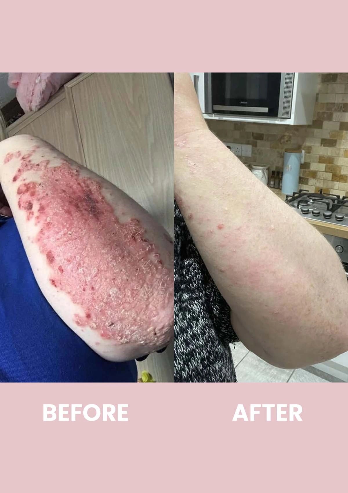 Before and after comparison of a person's arm with visible skin conditions in a kitchen setting.