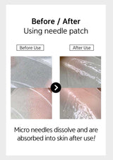 Before and after using needle patch with text explaining micro needles溶解 and absorption into skin.