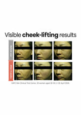 CLEARDEA Mucin Collagen EGF Fitting Mask: clinical cheek lifting photos