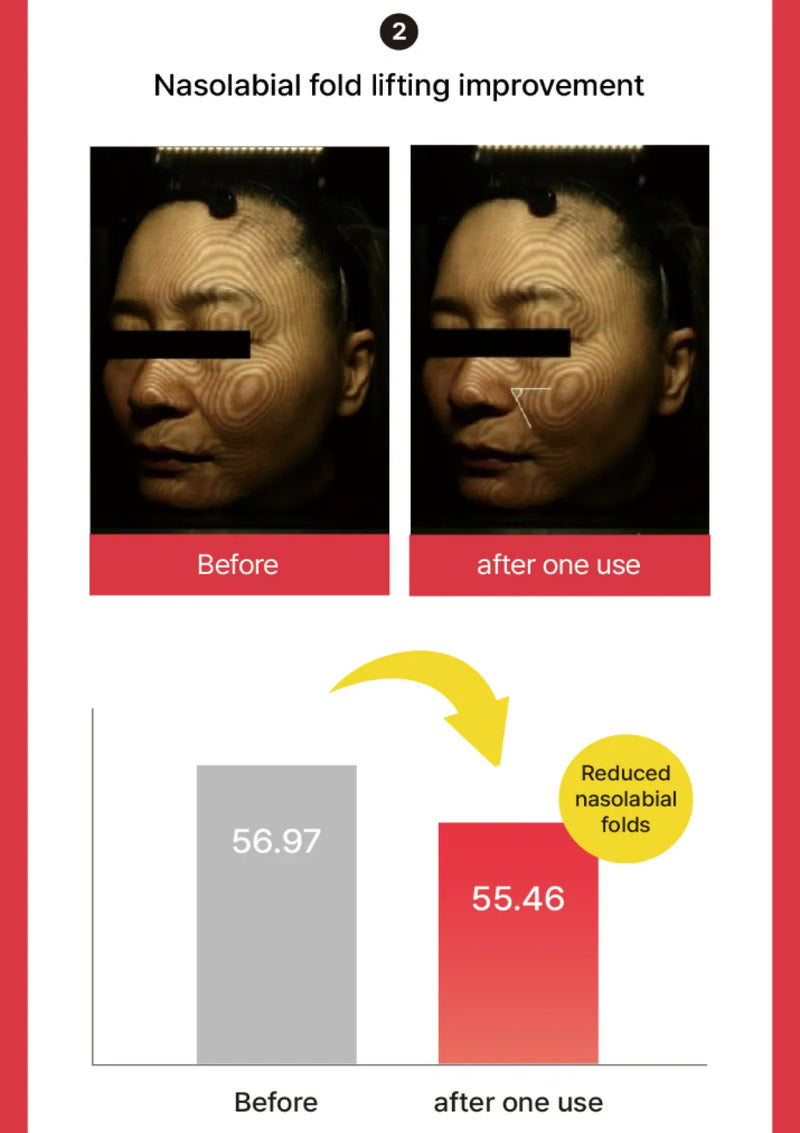 Before and after comparison of nasolabial fold lifting with a graph showing reduction in folds.