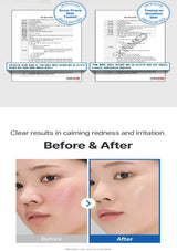 Before and after comparison of skin with redness and irritation, showing a clear result.