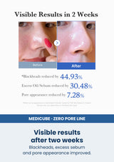 Medicube zero pore pad 2 0 1 box 70 pads — Visible results after two weeks. Blackheads, excess sebum and pore appearance improved.