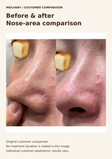 Original MOLVANY customer nose-area before-and-after comparison