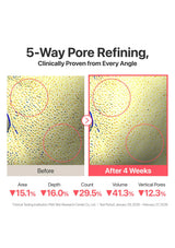 Before and after comparison of 5-way pore refining treatment with clinical data on a white background.